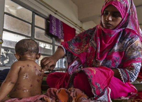 উনিশ দিনে হামের উপসর্গ নিয়ে দেশে ৯৪ শিশুর মৃত্যু