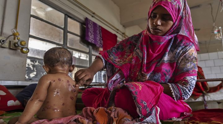 উনিশ দিনে হামের উপসর্গ নিয়ে দেশে ৯৪ শিশুর মৃত্যু