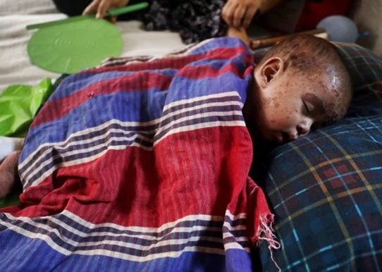 হাম ও উপসর্গ নিয়ে চব্বিশ ঘণ্টায় ১২ জনের মৃত্যু